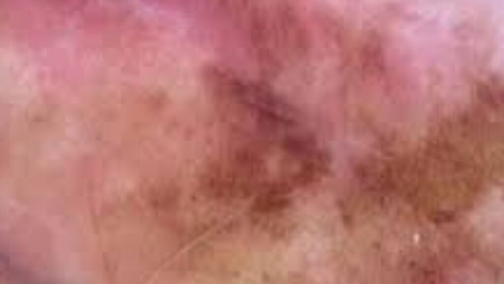 How Many Stages Are There In Penis Melanosis Cancer?