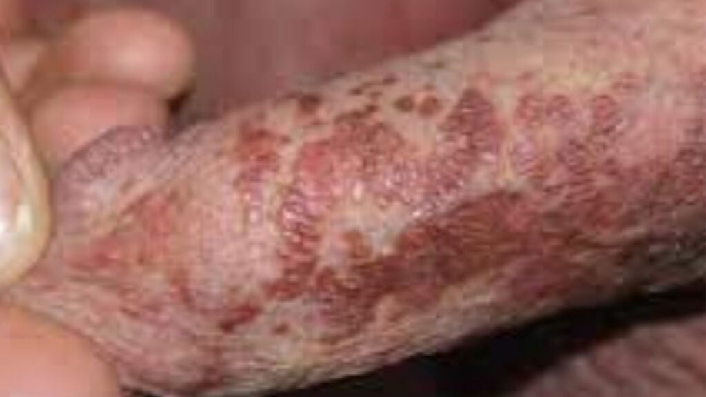 Penile Melanosis: Symptoms, Treatment, And Penile Cancer cause