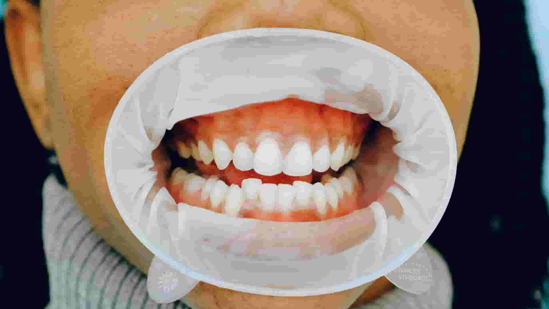 Read more about the article Cavity Vs Stain, Symptoms, Oral Health, How do Cavities & Stains look